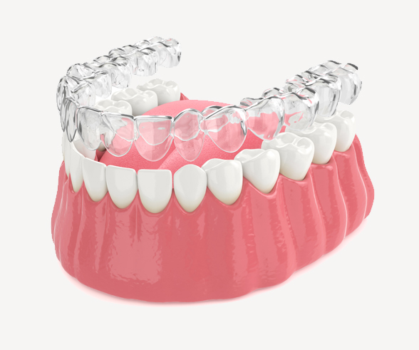 How-Clear-Aligners-Work