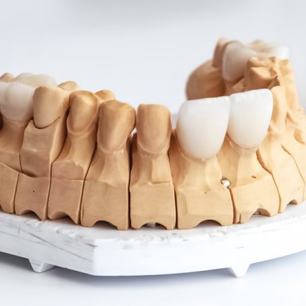 Before and After Veneers: What to Expect from Your Smile Makeover