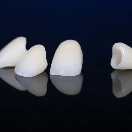 Are Dental Crowns Worth It? Expert Insights for Paramount, CA Residents