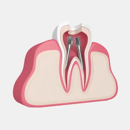 How Root Canal Therapy in Paramount, CA Can Stop Severe Tooth Pain Fast