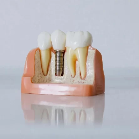 Why-Dental-Implants-Are-the-Gold-Standard-for-Replacing-Missing-Teeth